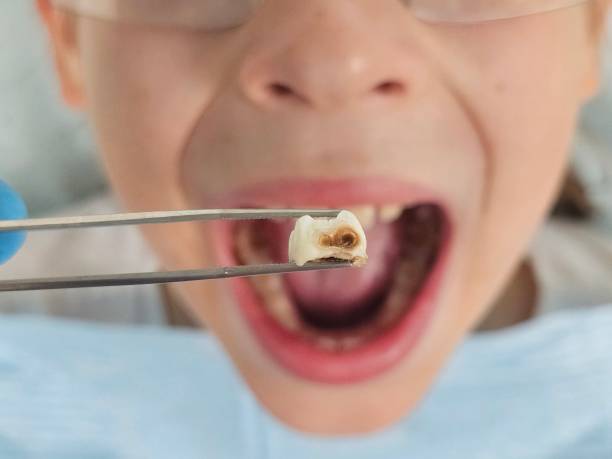 Best Emergency Tooth Extraction in Hayden, AL